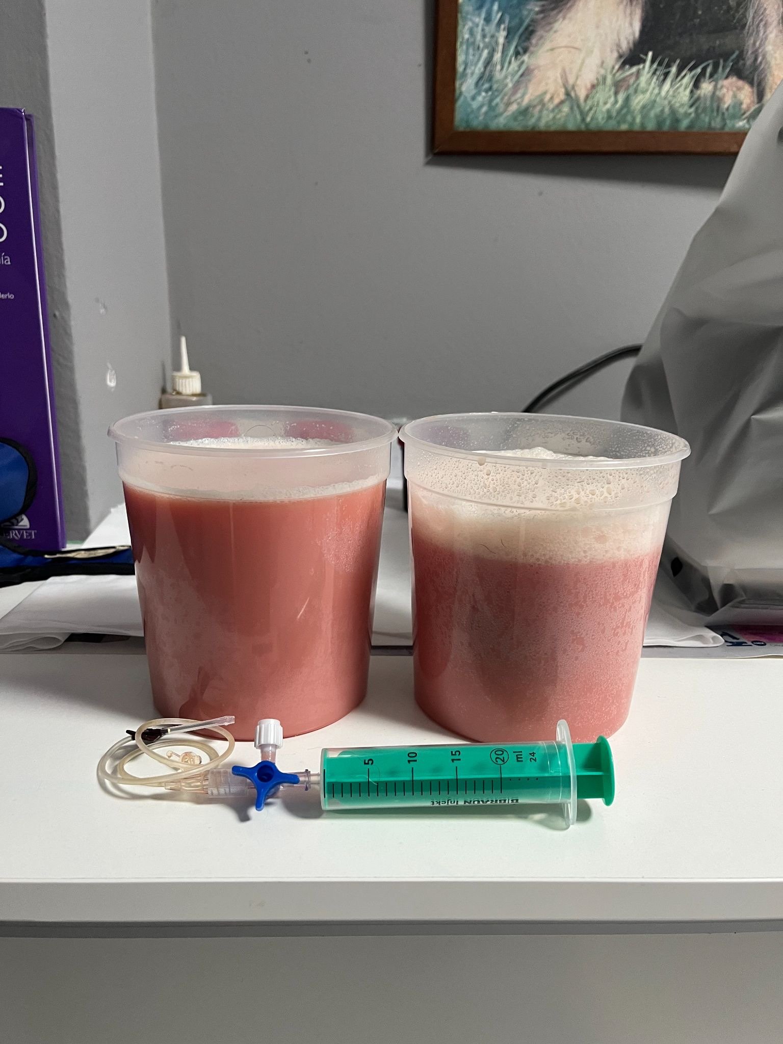 Liquido quilotorax