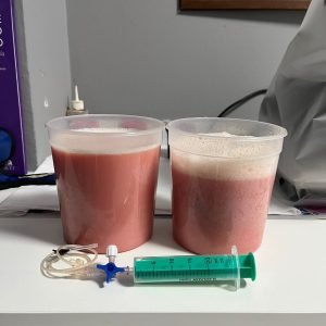 Liquido quilotorax